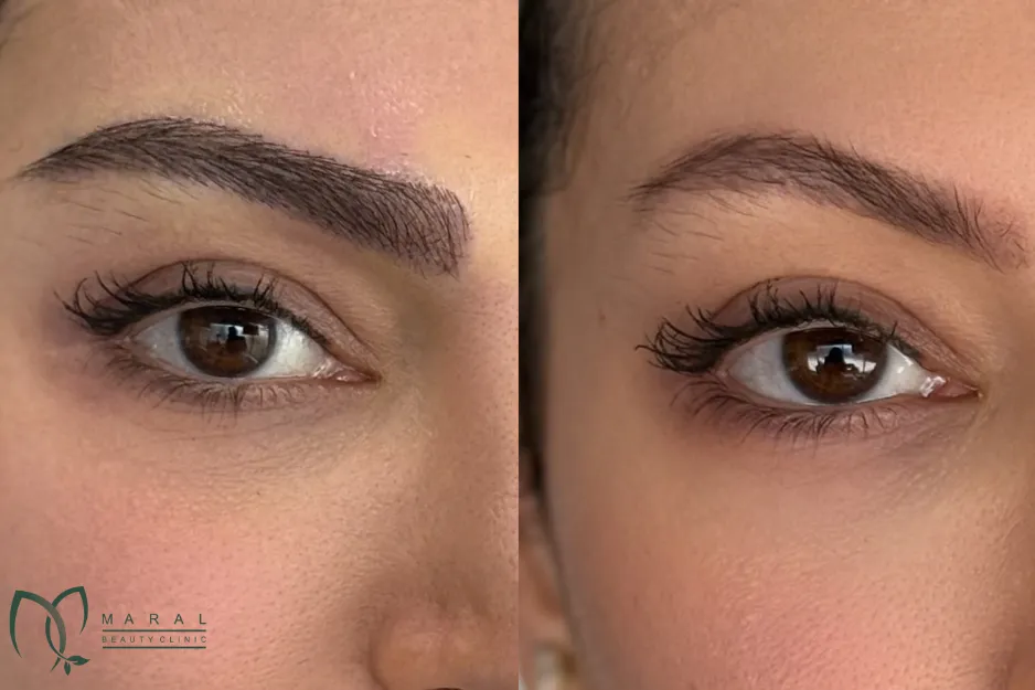 کاشت ابرو برای بیماران ام اس