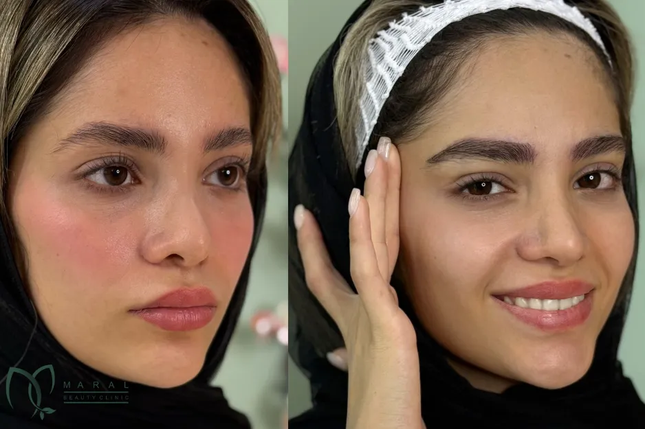 کاشت ابرو برای بیماران ام اس
