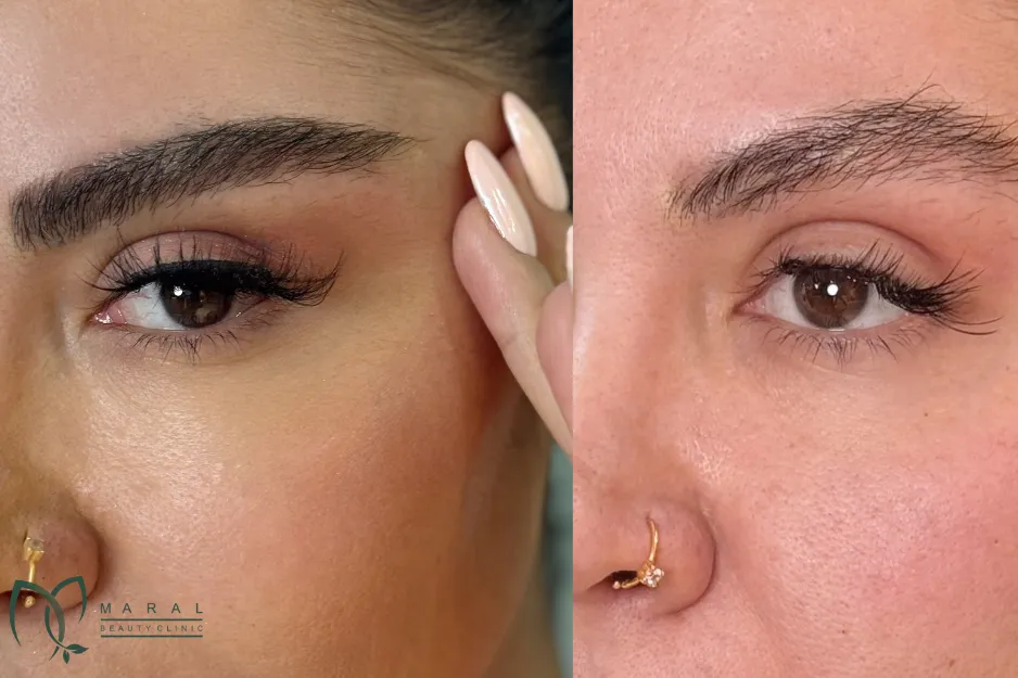 کاشت ابرو برای بیماران ام اس