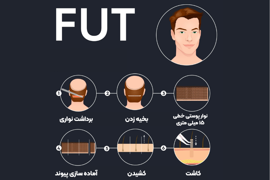 کاشت ابرو به روش FUT