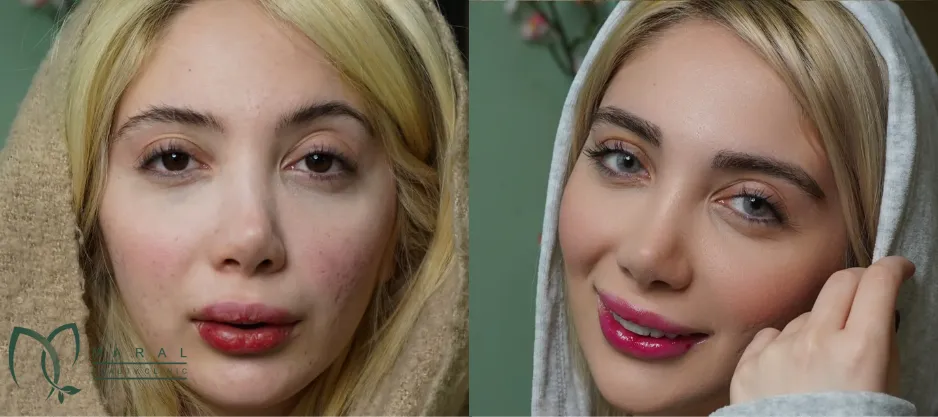 بهترین سن برای کاشت ابرو