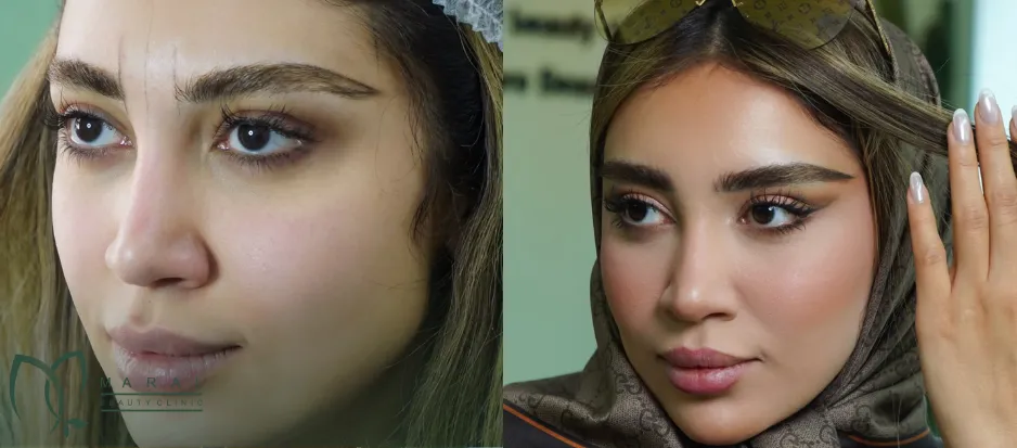 بهترین سن برای کاشت ابرو