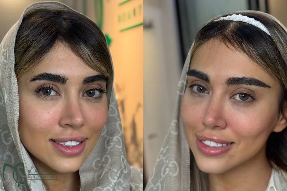 کاشت ابرو روی تاتو