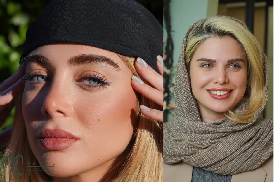 عکس ریزش ابرو بعد از کاشت
