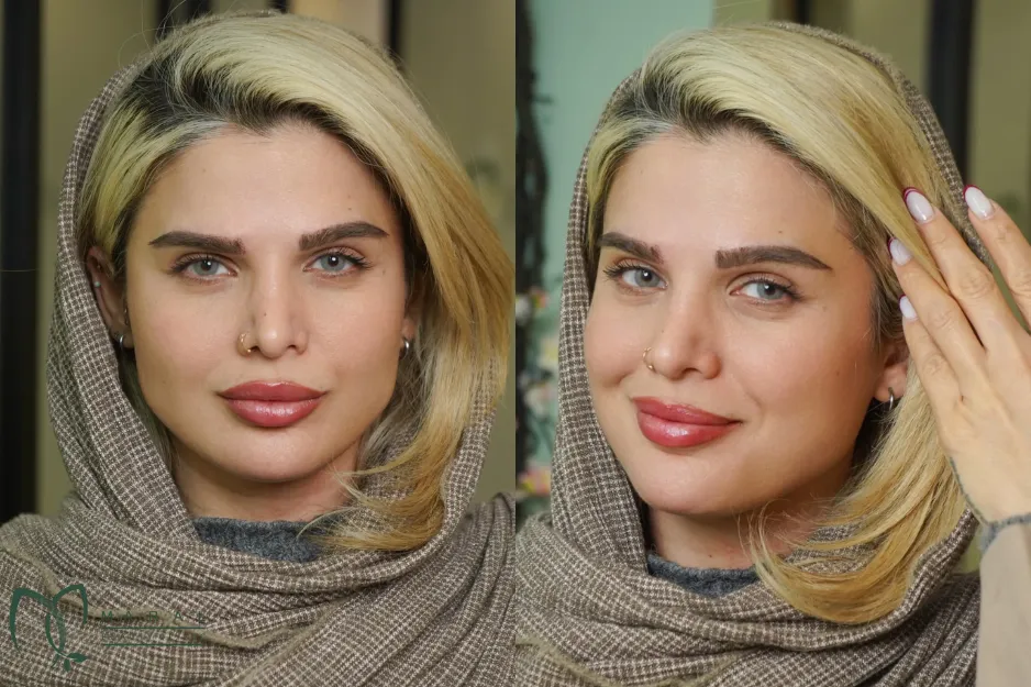 عکس ریزش ابرو بعد از کاشت