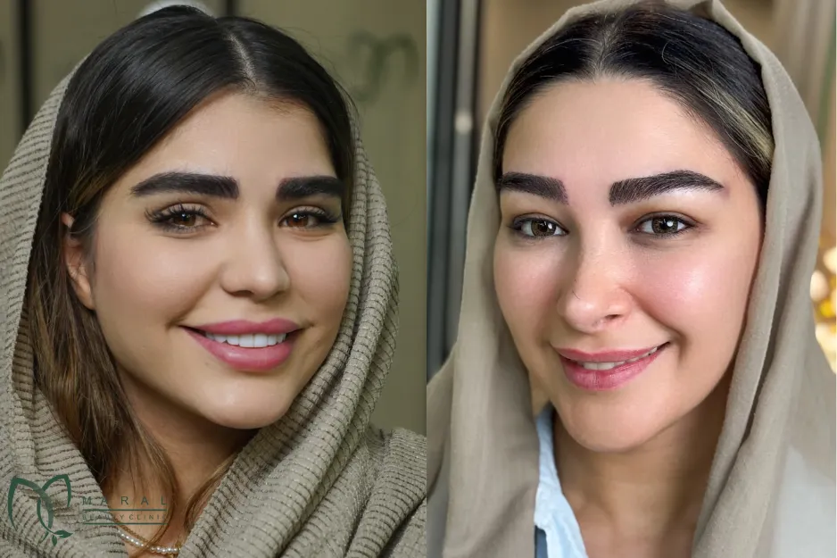 عکس ریزش ابرو بعد از کاشت