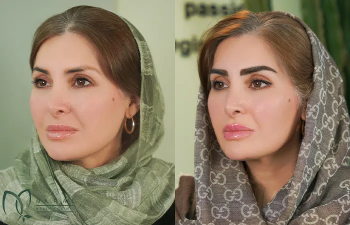 عوارض کاشت ابرو
