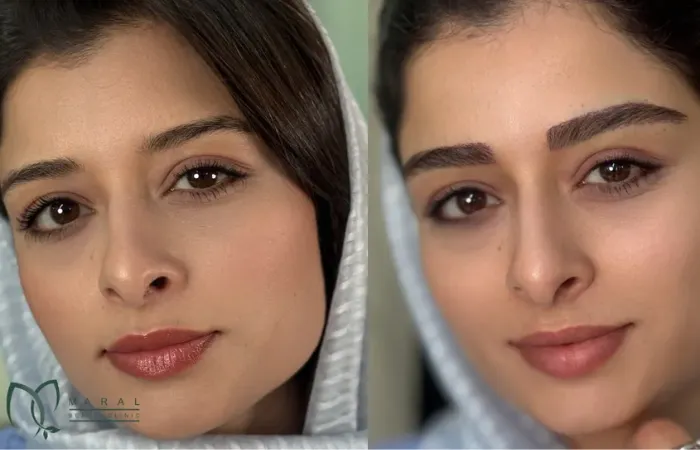 پرسش و پاسخ در مورد کاشت ابرو