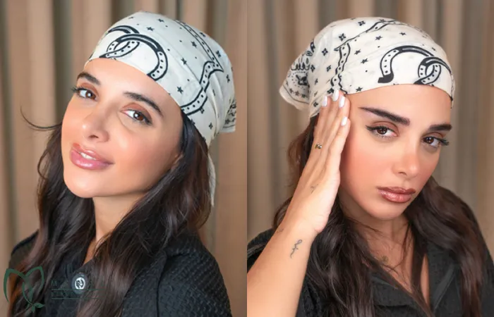 عوارض کاشت ابرو