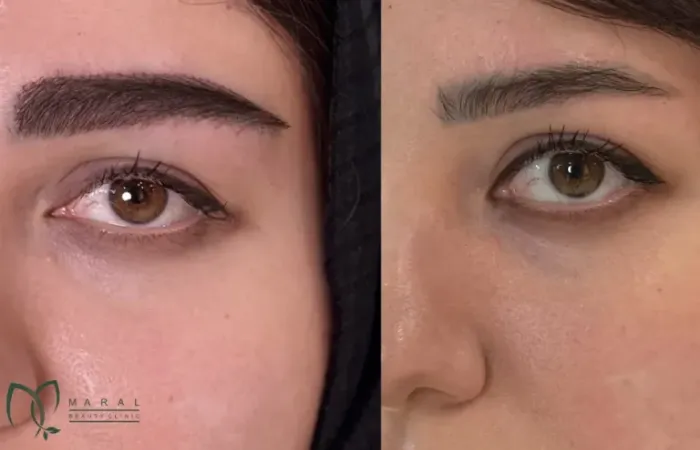 پرسش و پاسخ در مورد کاشت ابرو