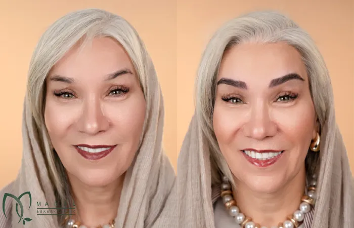 عوارض کاشت ابرو