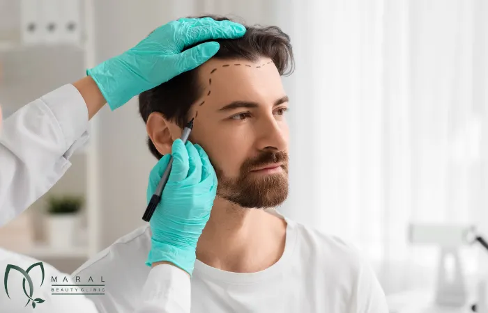 عوارض کاشت مو برای بچه دار شدن
