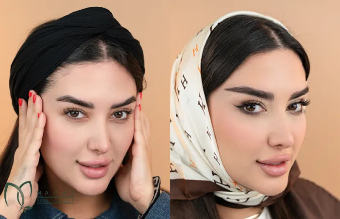 نتیجه کاشت ابرو بعد از سه ماه
