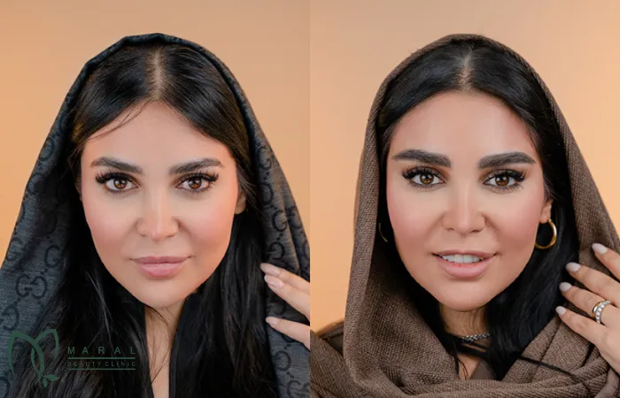 ده روز بعد از کاشت ابرو