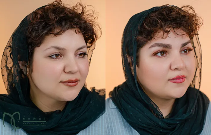 تغذیه بعد از کاشت ابرو