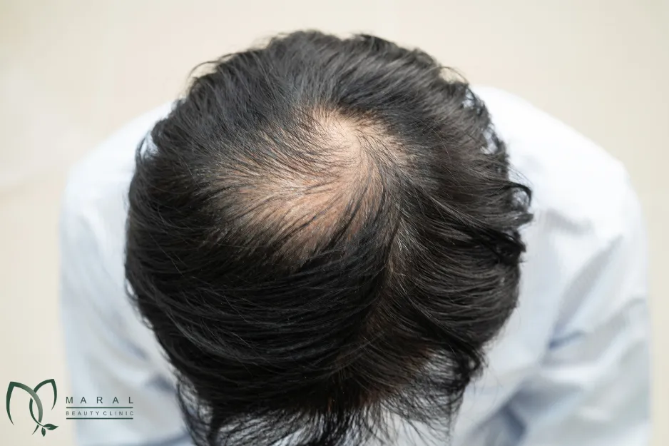 بعد از کاشت مو چند روز باید استراحت کرد؟