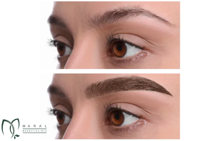 کاشت ابرو در بارداری
