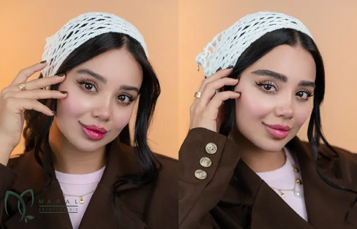 کاشت ابرو برای چه کسانی مناسب است؟