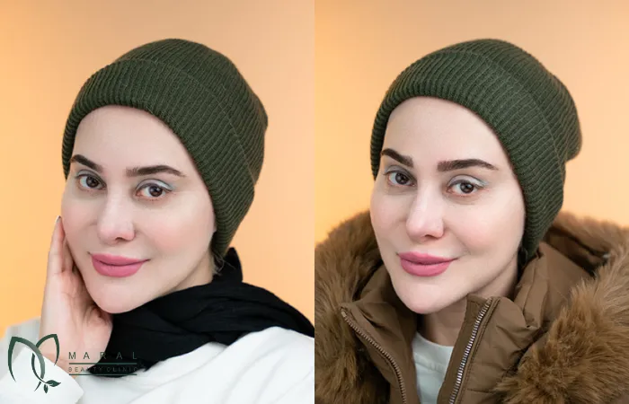 کاشت ابرو برای چه کسانی مناسب است؟
