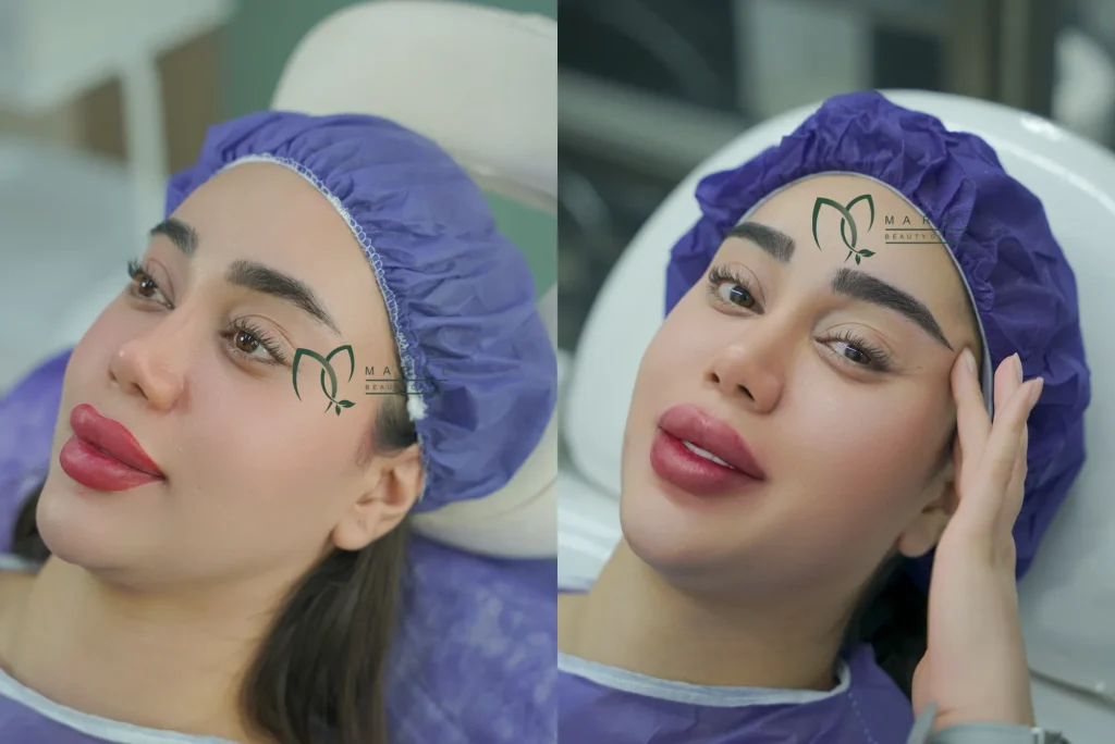 عکس قبل و بعد کاشت ابرو