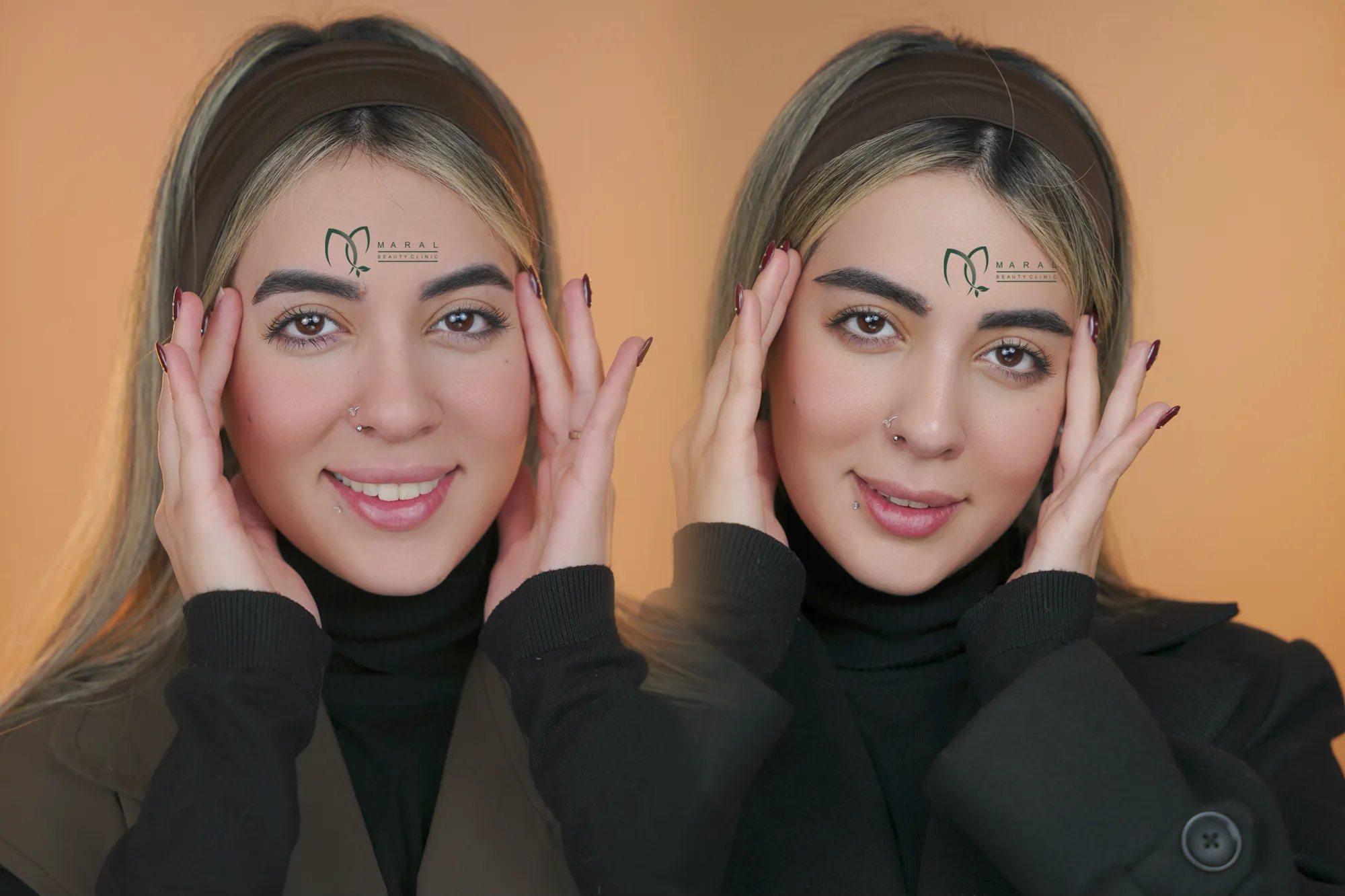 کاشت ابرو طبیعی