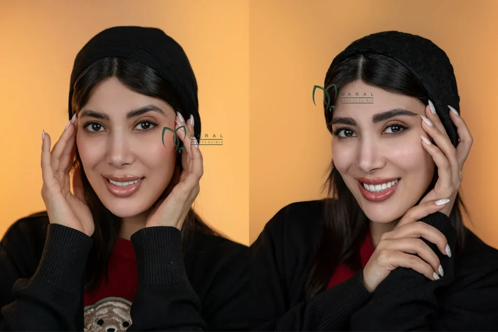 قبل و بعد کاشت ابرو