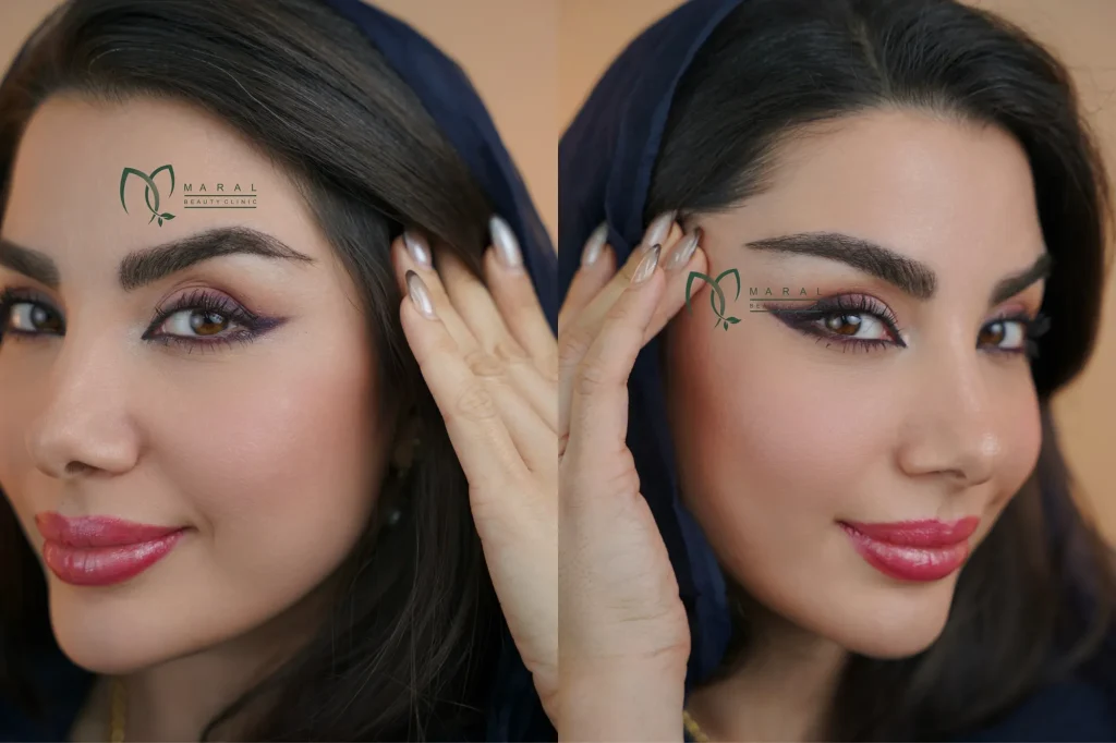 کاشت ابرو قبل و بعد