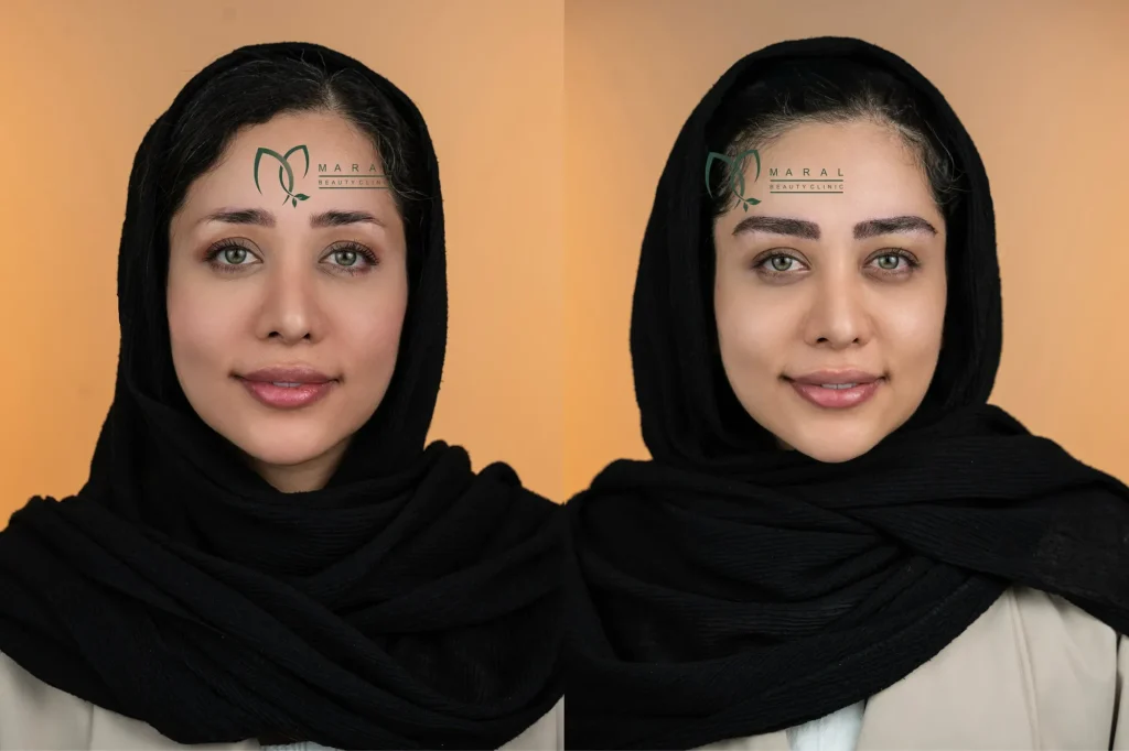عکس کاشت ابرو طبیعی