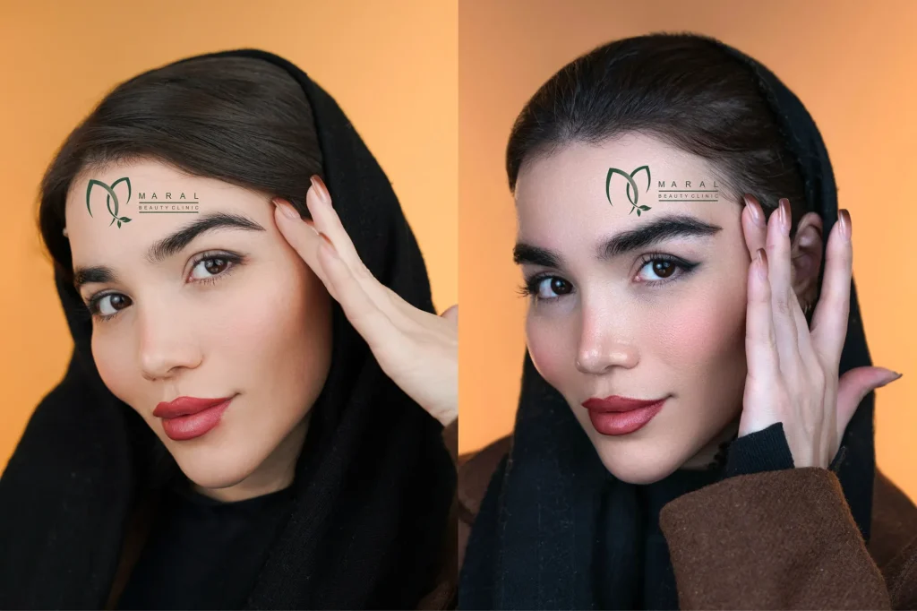 عکس کاشت ابرو طبیعی