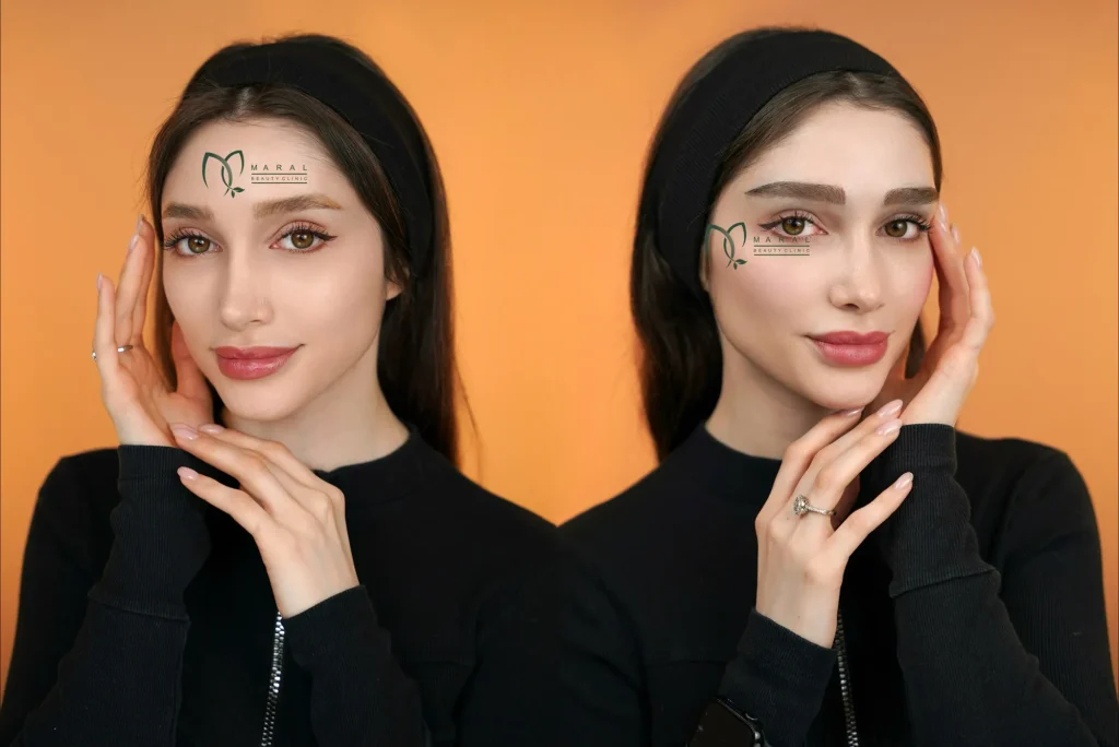 عکس کاشت ابرو طبیعی