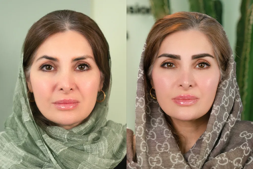 چند روز بعد از کاشت ابرو میتوان قیچی کرد