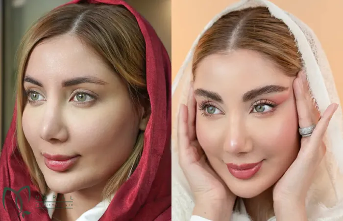 بهترین روش کاشت ابرو کدام است؟