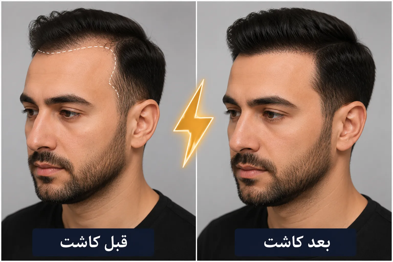 قبل و بعد از کاشت مو شقیقه
