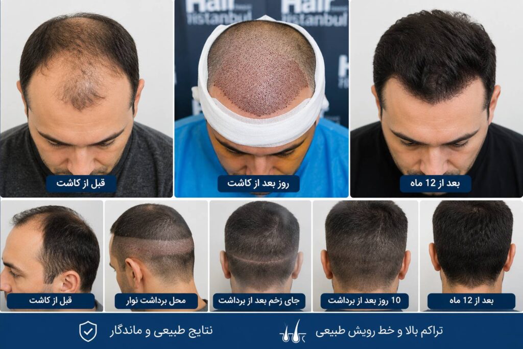0 تا 100 کاشت مو به روش FUT + هزینه، مزایا و مراحل