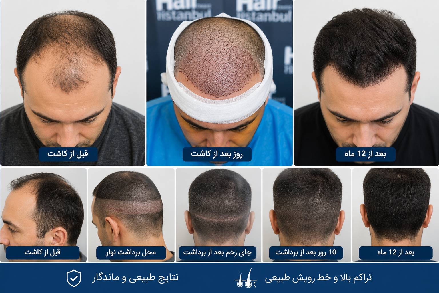 0 تا 100 کاشت مو به روش FUT + هزینه، مزایا و مراحل