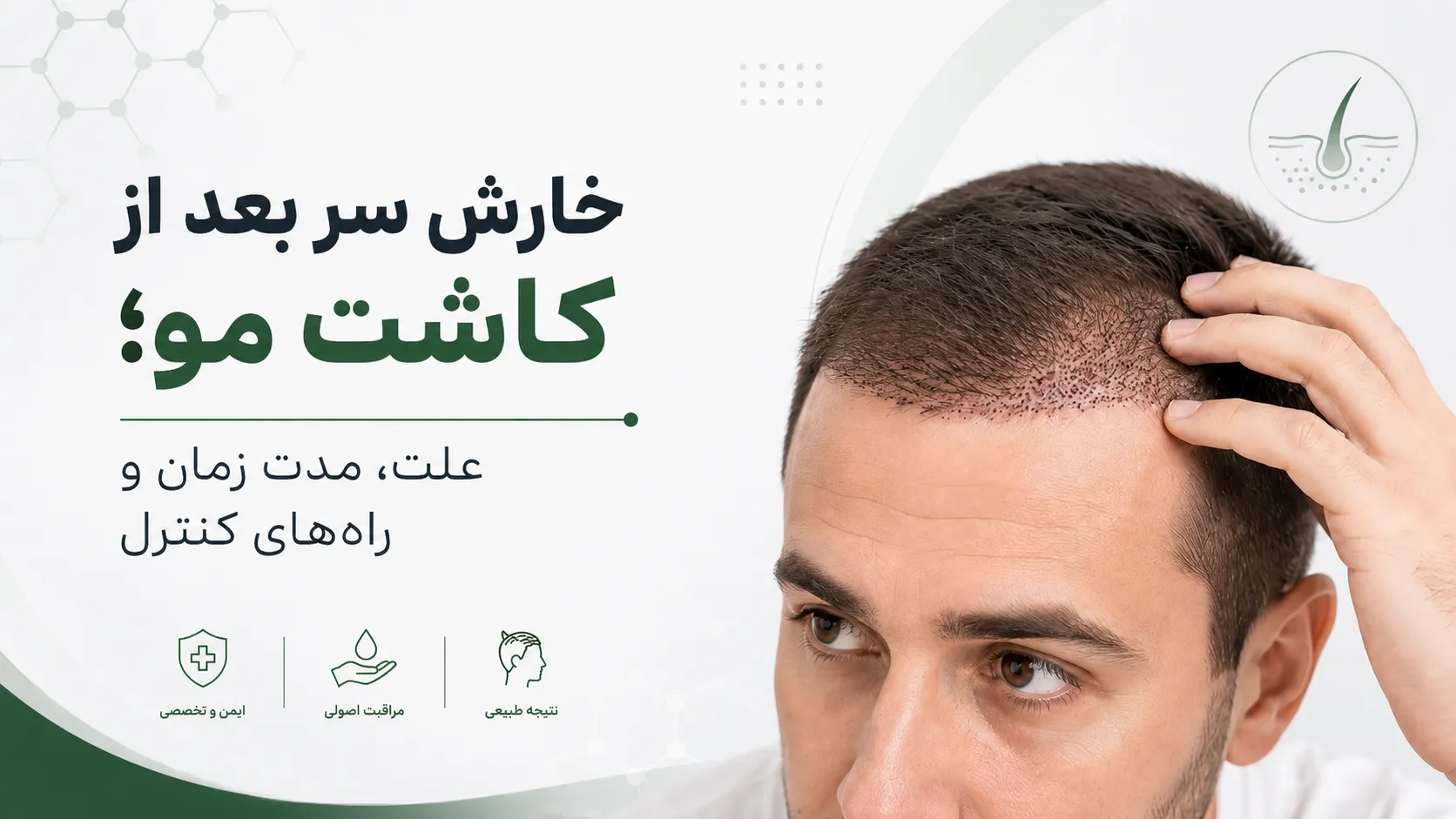 خارش سر بعد از کاشت مو و بررسی علت، مدت زمان بهبود و راه‌های کنترل آن