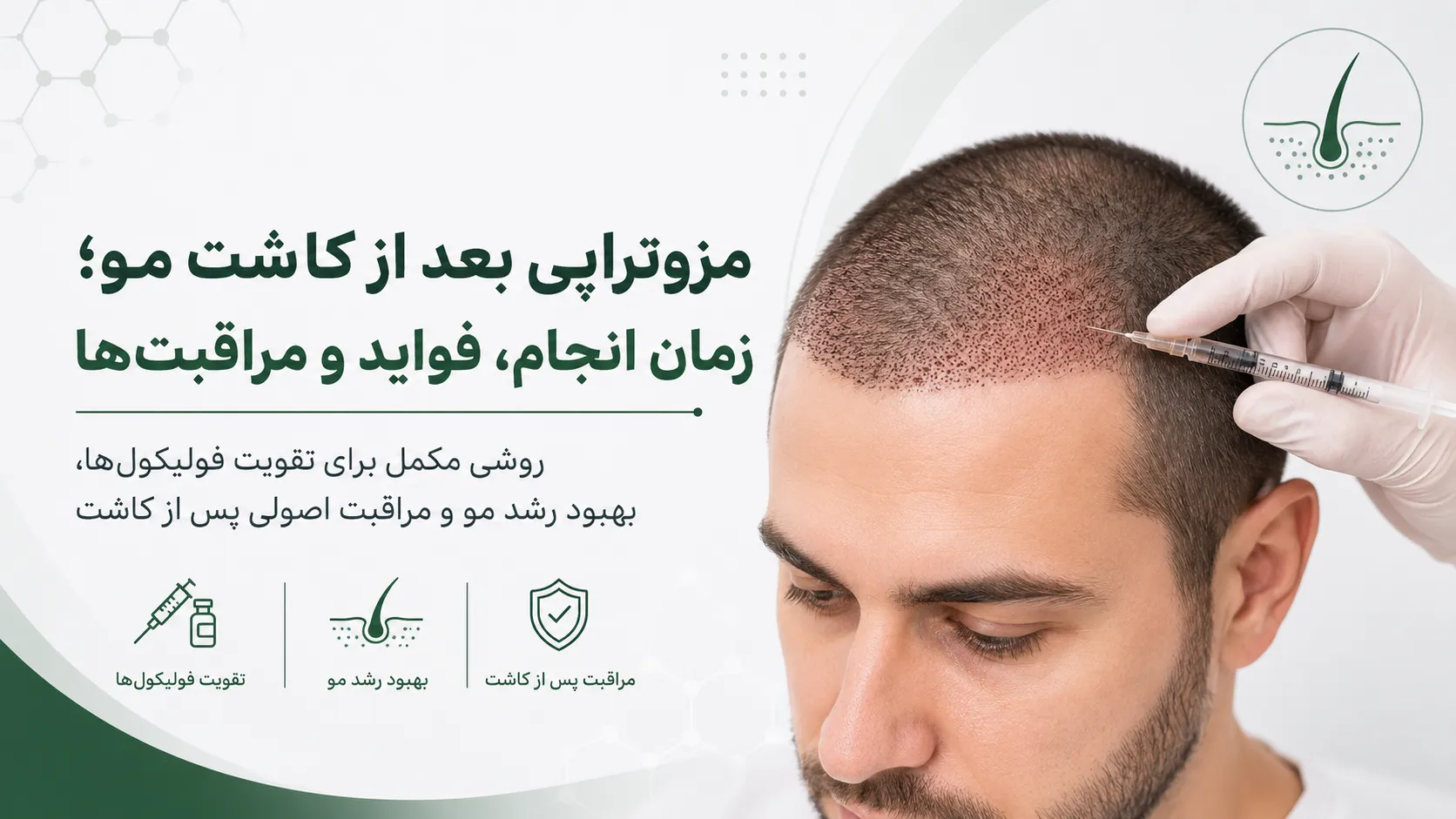 مزوتراپی بعد از کاشت مو با تمرکز بر زمان انجام، فواید و مراقبت‌های پس از درمان