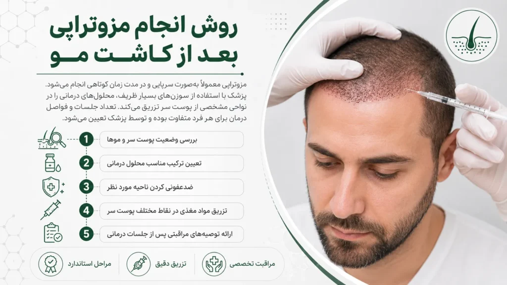 روش انجام مزوتراپی بعد از کاشت مو به‌صورت مرحله‌به‌مرحله و تزریق مواد مغذی به پوست سر
