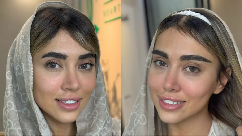 عکس قبل و بعد کاشت ابرو با فرم اصلاح شده ابرو