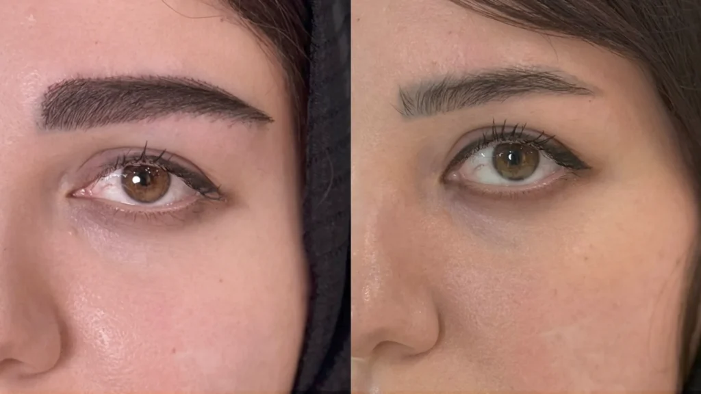 عکس واقعی قبل و بعد کاشت ابرو با تراکم بالا