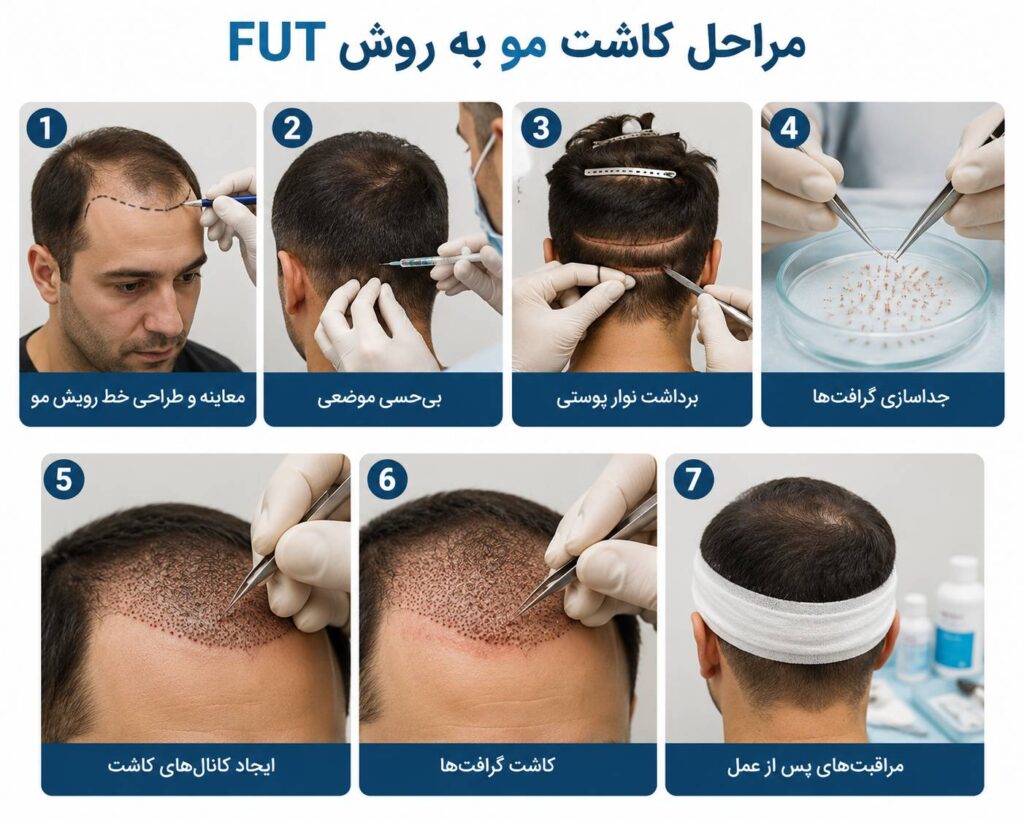 مراحل کاشت مو به روش اف یو تی