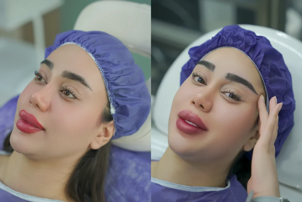 نتیجه کاشت ابرو قبل و بعد با طراحی هماهنگ صورت
