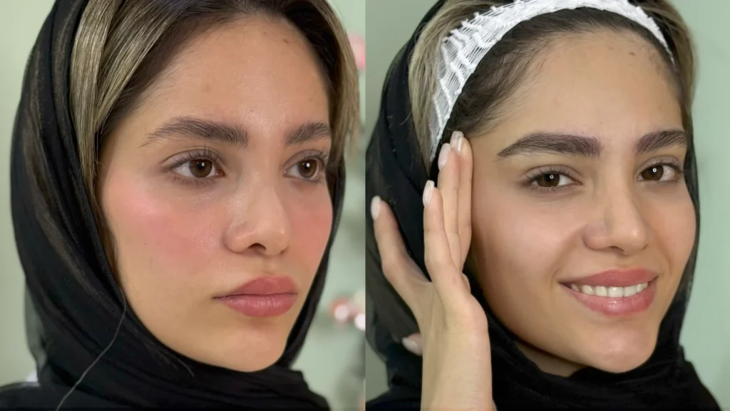 نمونه کاشت ابرو طبیعی برای پر کردن نواحی خالی